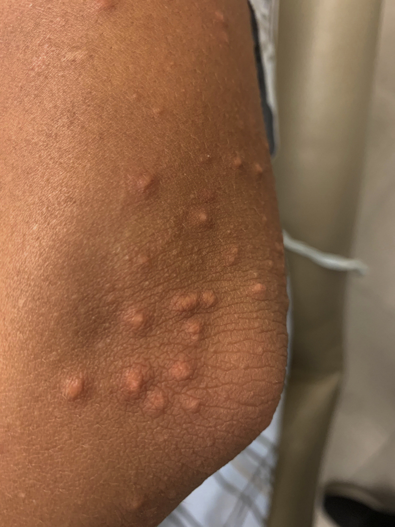 Xanthoma